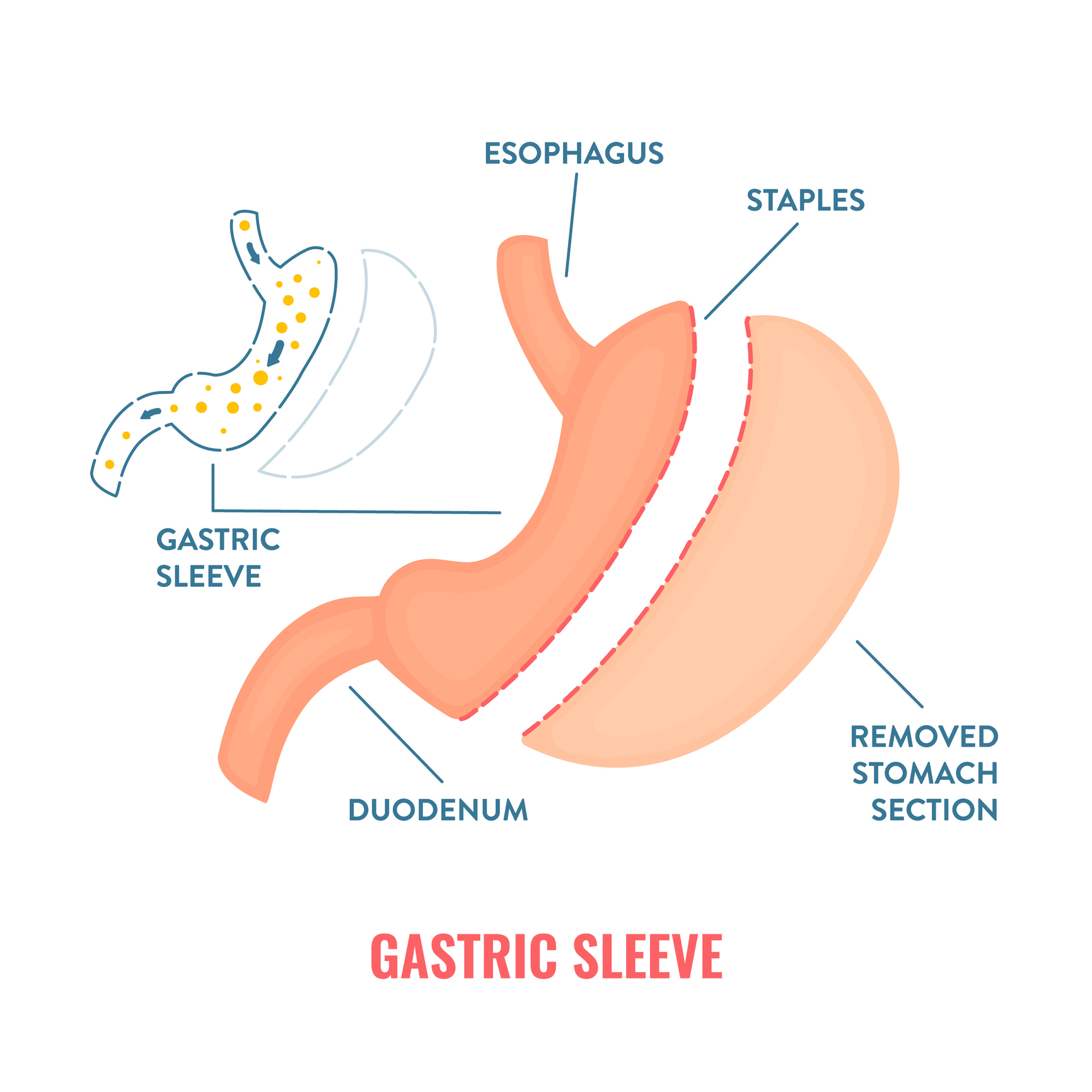 Gastric Sleeve (Sleeve Gastrectomy) Surgery